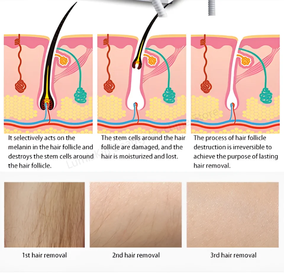 FEMUN 4000W Ice Cooling Diode Laser Hair Removal Device 755 940 1064 808nm